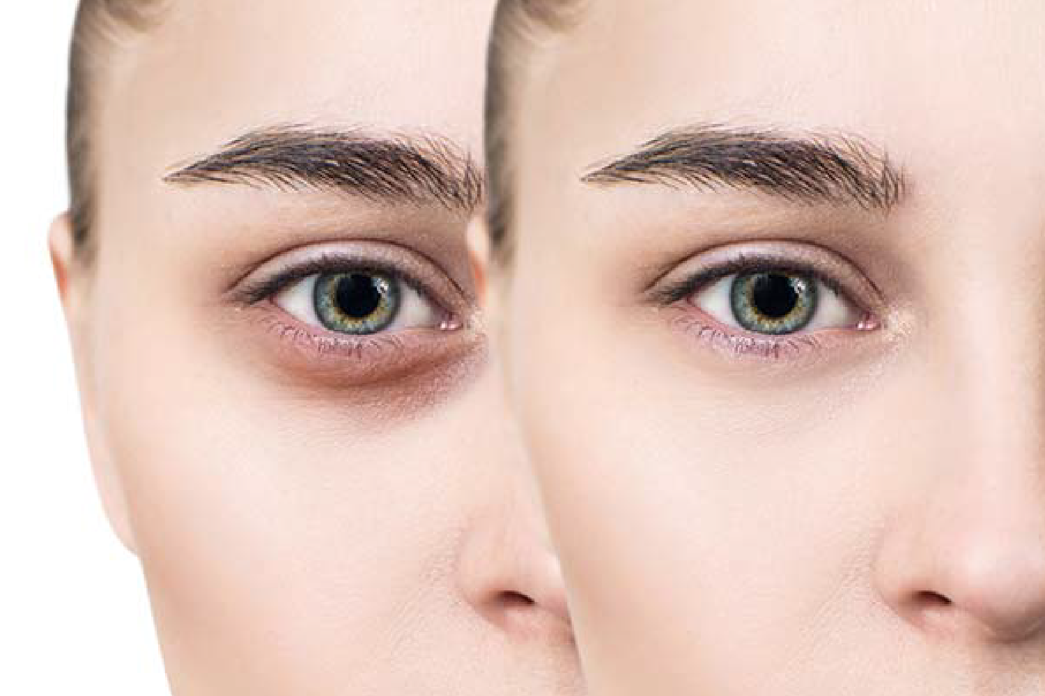 Mắt sáng sạch thâm với công nghệ ipac laser trị thâm quầng mắt